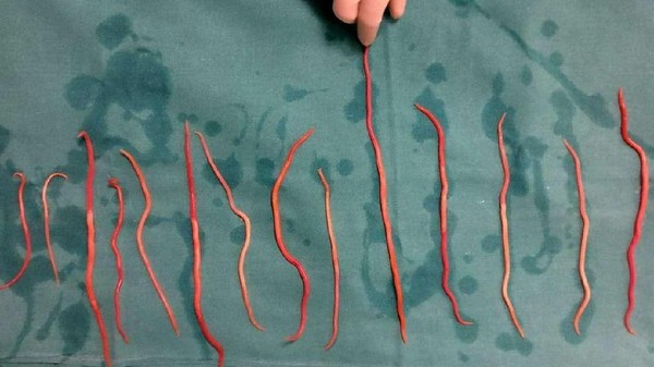 Raya, Balita di Sukabumi Meninggal, Tubuh Dipenuhi Cacing